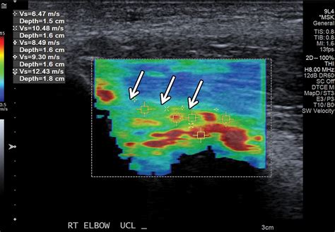 Diagnostic utility of shear wave elastography in musculoskeletal 